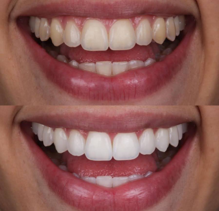 Resultado da Dra. Paloma Boiko, aluna da Comunidade CZS. O método é replicável e transforma sorrisos sem dor